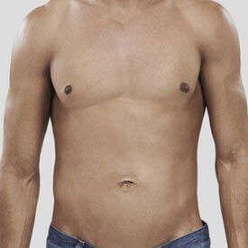 Gynecomastia in Atlanta GA Dr. Fara Movagharnia